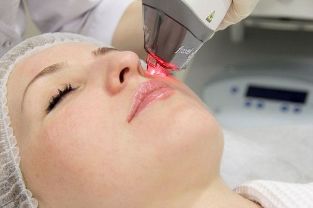 Proceso de rejuvenecimiento de la piel facial con láser fraccionado