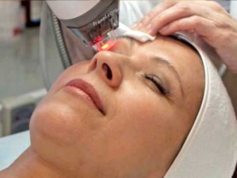 rejuvenecimiento con láser de la piel alrededor de los ojos